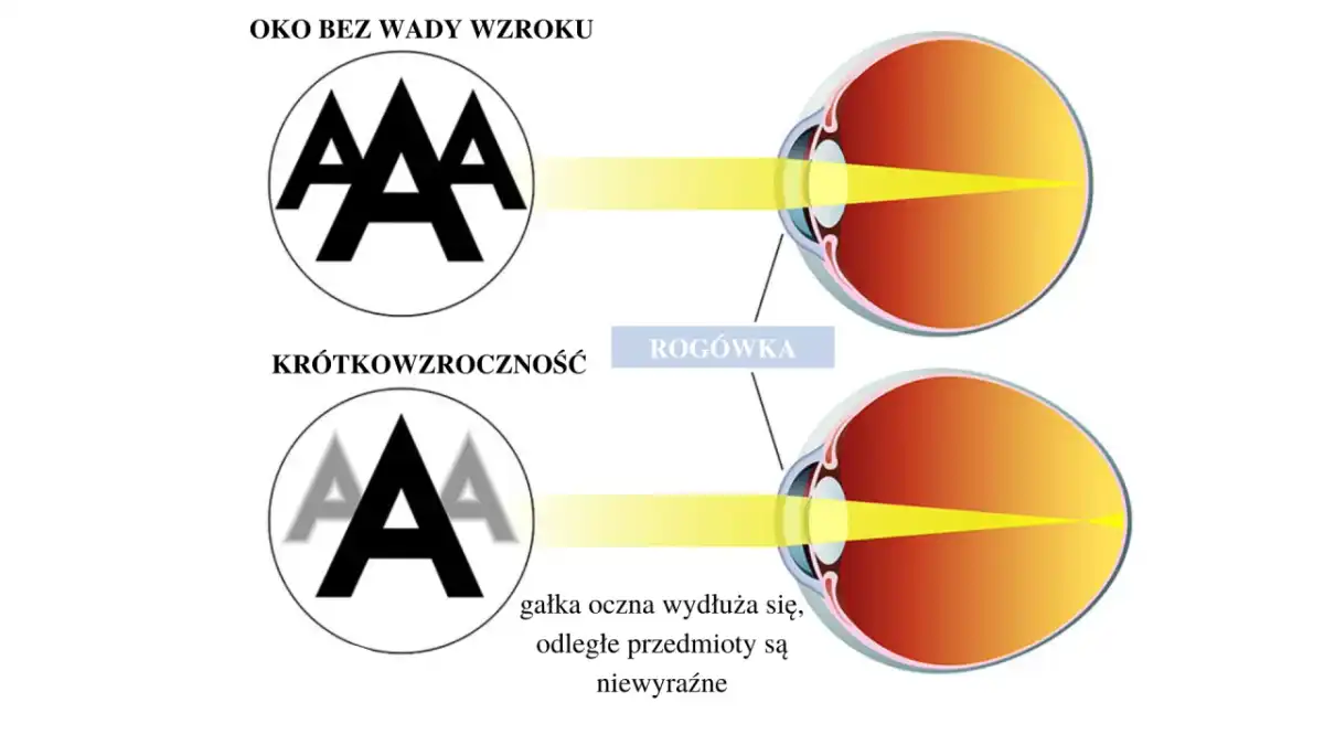 Krótkowzroczność - Czy wiesz, jak ją kontrolować?