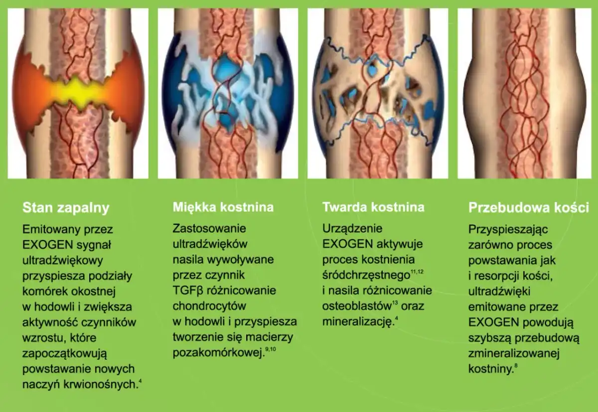 Ile zrasta się kość po złamaniu? Czas, czynniki, pierwsza pomoc