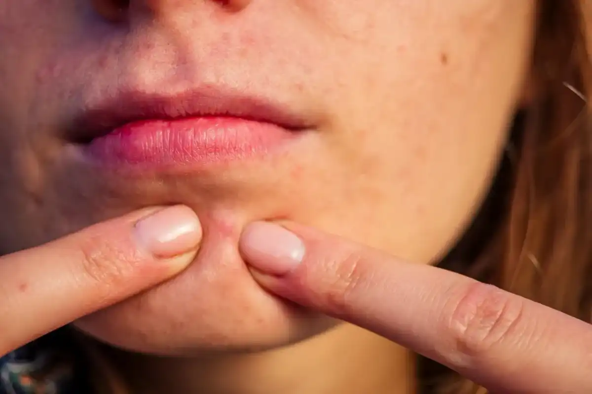 Espinilla inflamada: ¿Qué hacer y cuándo ir al dermatólogo?