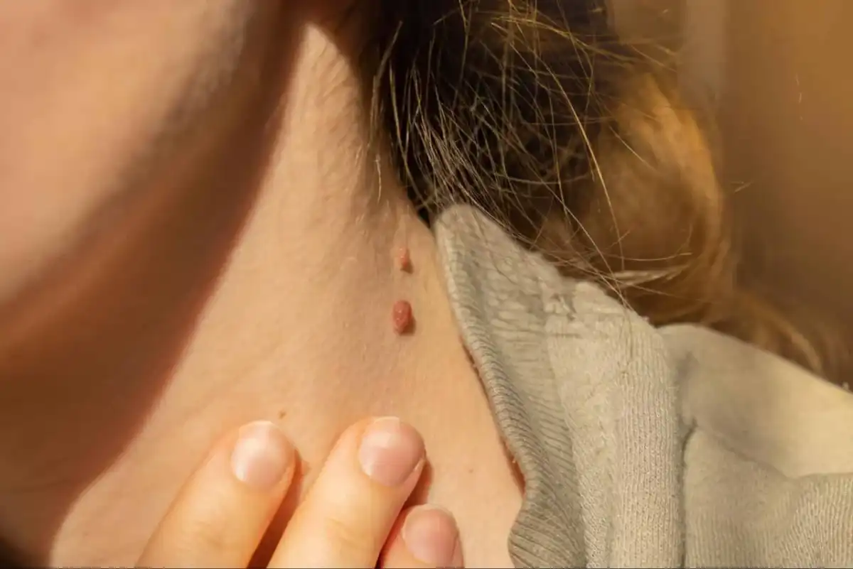 ¿Verrugas en el cuello? Distingue y retira con seguridad