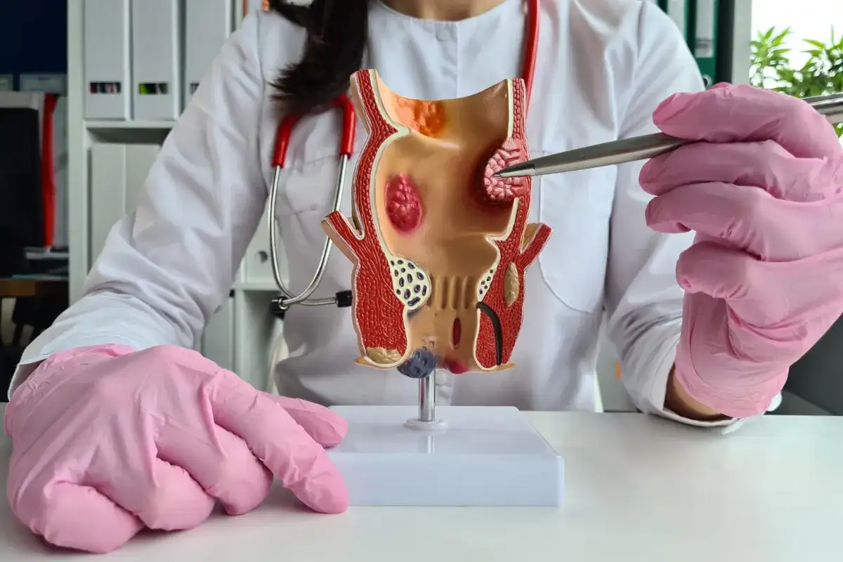 Model jelita grubego z widocznymi hemoroidami, często pojawiającymi się po porodzie. Lekarz w różowych rękawiczkach wskazuje na problem.