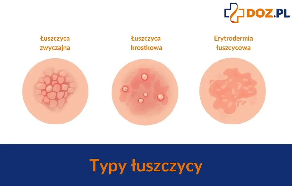 Ilustracje pokazują różne typy łuszczycy: zwyczajną, krostkową i erytrodermię łuszczycową. Ważne, by znać objawy łuszczycy u dzieci.