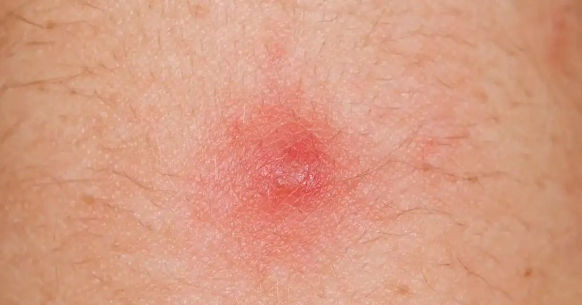 Czerwona, zapalna krostka na skórze, która może wymagać leczenia detreomycyną.