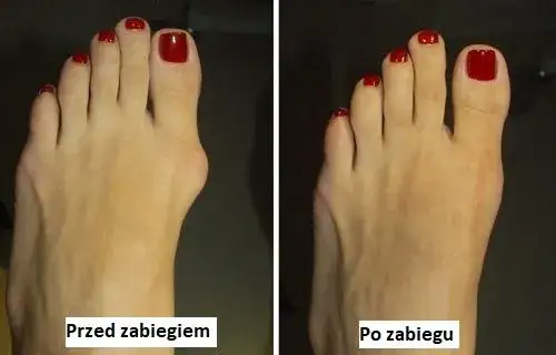 Operacja haluksa: Poznaj metody i odzyskaj stopę bez bólu
