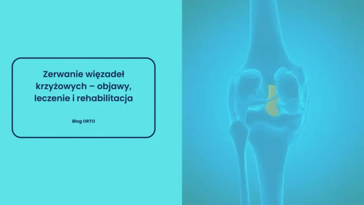 Ilustracja przedstawia zerwane więzadło krzyżowe w kolanie. Czy zerwane więzadło boli? Dowiedz się o objawach, leczeniu i rehabilitacji.