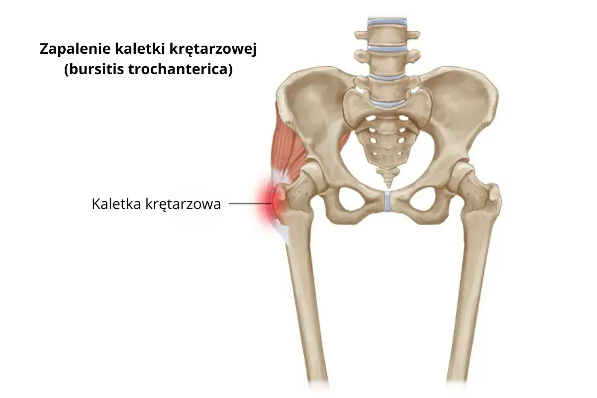 Zapalenie kaletki krętarza większego – ilustracja anatomiczna miednicy i uda z zaznaczonym bolącym obszarem.