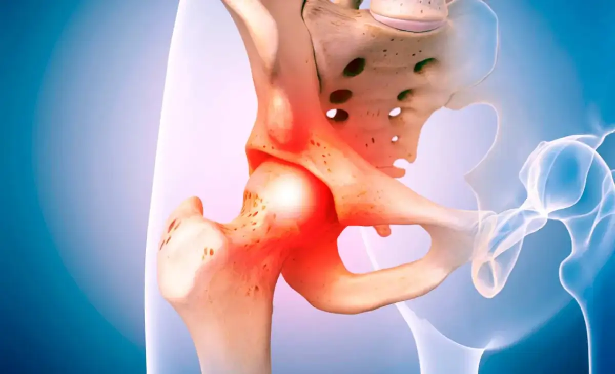 Anatomical illustration of a hip joint with inflamed areas indicating bolące biodra.
