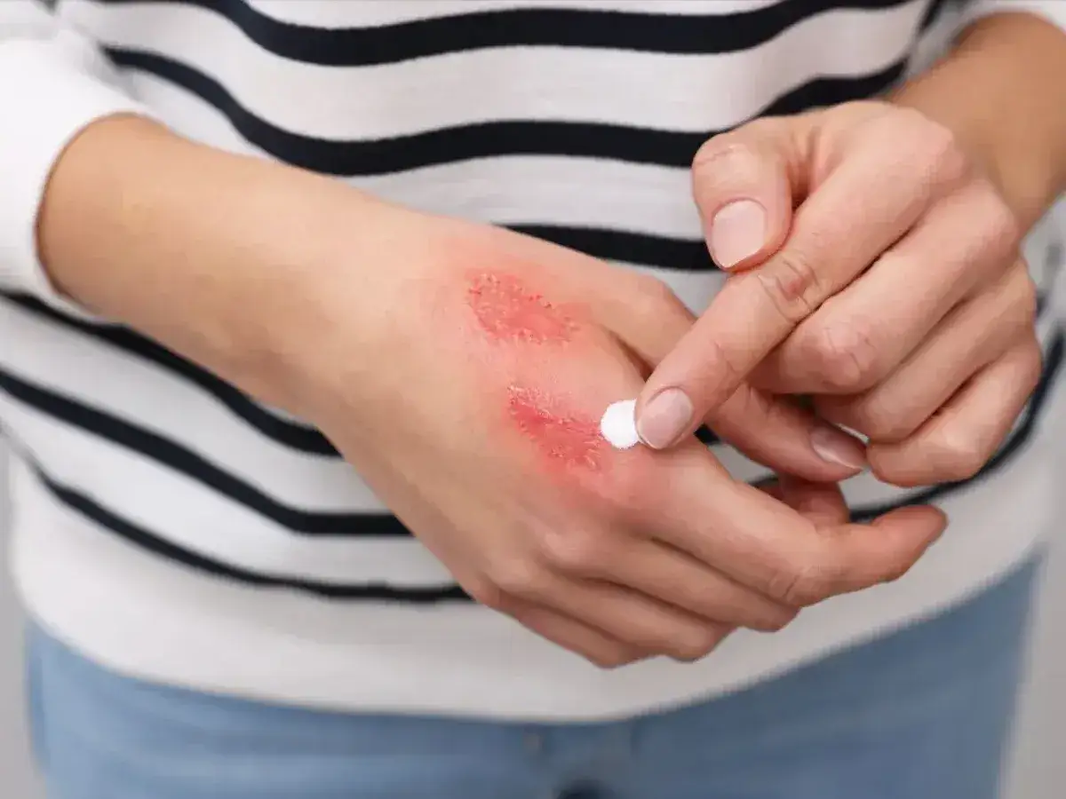 Oparzenie gazem LPG co robić - skuteczne kroki pierwszej pomocy