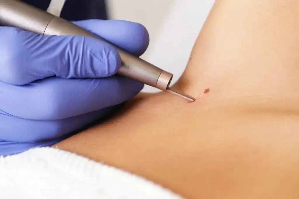 Jaki lekarz usuwa pieprzyki? Sprawdź, jak uniknąć problemów zdrowotnych