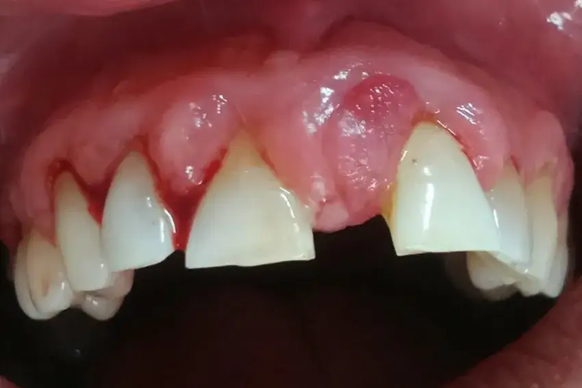 Antybiotyki na zapalenie dziąseł: Kiedy są potrzebne?