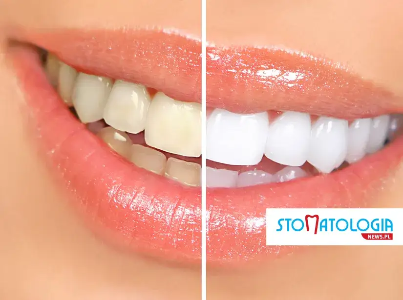 Wybielanie zębów u dentysty: czy to opłacalna inwestycja?