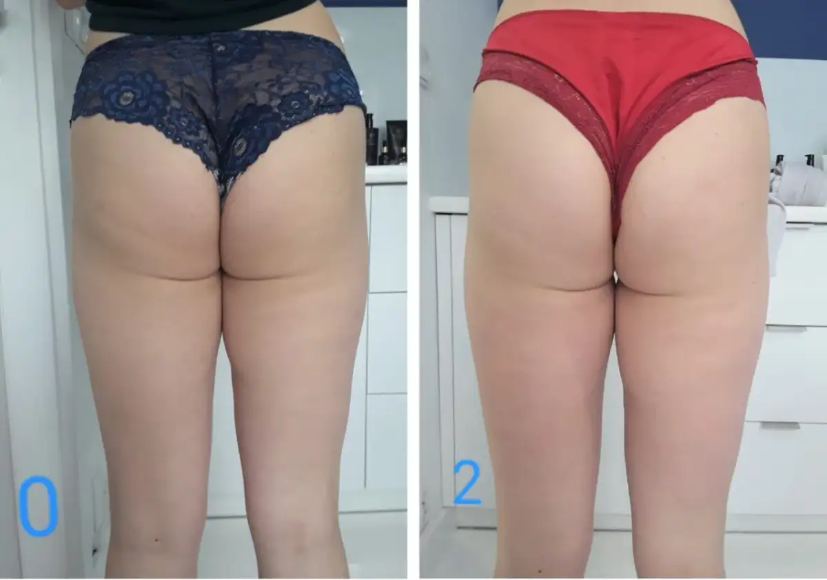 Porównanie ud przed i po zabiegu. Widoczne zmiany w wyglądzie skóry, sugerujące jak się pozbyć cellulitu.