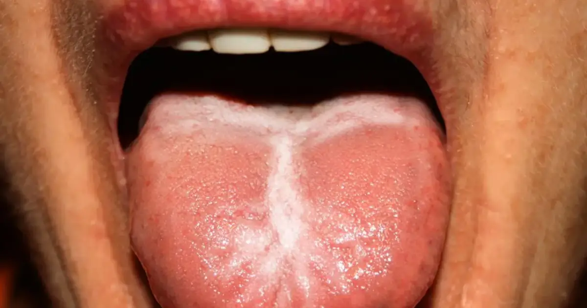 Biały język: co mówi o Twoim zdrowiu? Przyczyny i leczenie