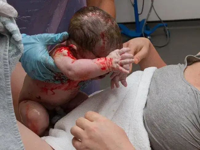 Jak przebiega poród pośladkowy? Kluczowe informacje i ryzyka.