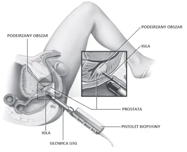 Biopsja prostaty: Co musisz wiedzieć? Przebieg, przygotowanie, wyniki