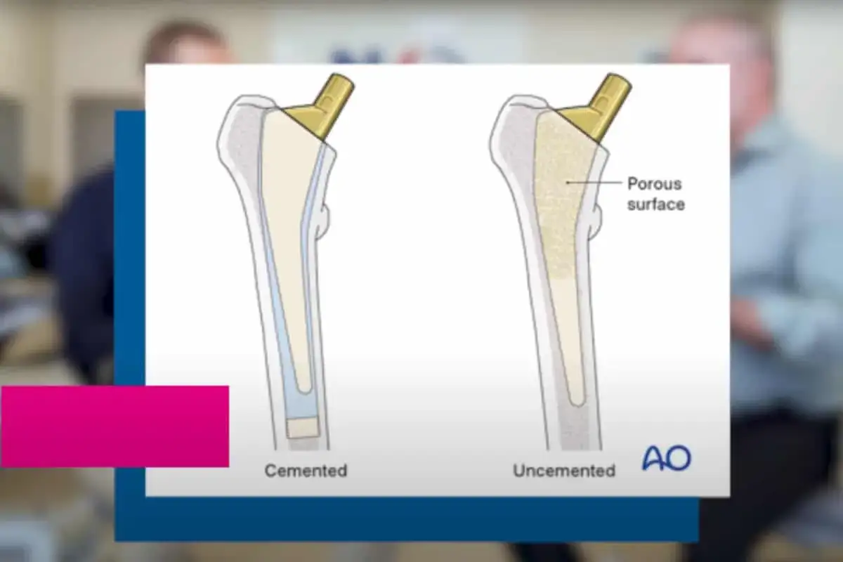 Ilustracja porównująca endoprotezę cementowaną i bezcementową stawu biodrowego.