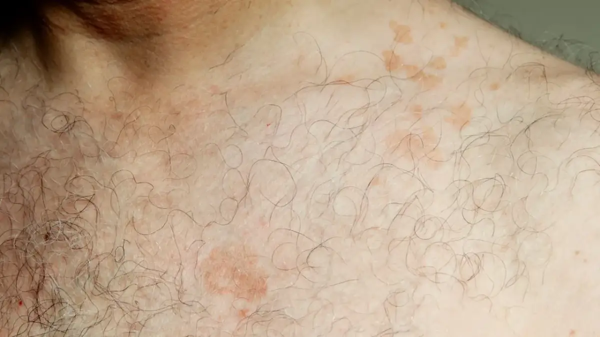 Łupież pstry: objawy, kolory, odbarwienia. Czy to Twój problem?