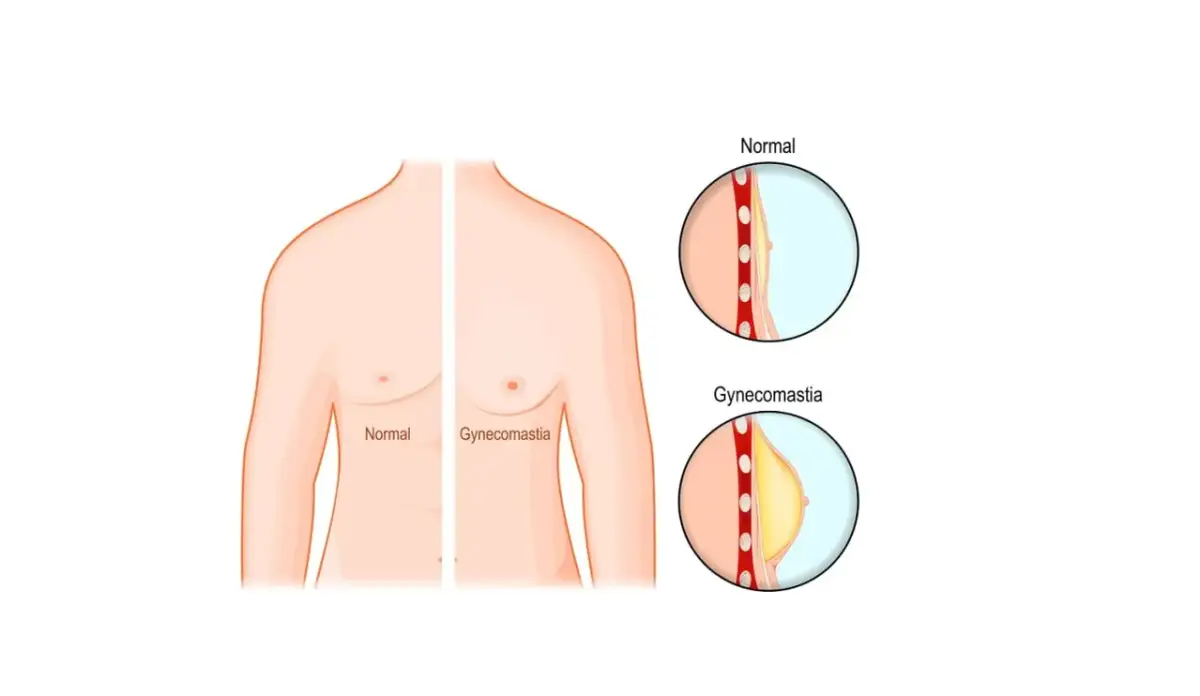 Ginekomastia jaki lekarz - jak uniknąć błędnych diagnoz i leczenia