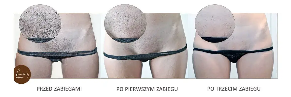 Depilacja laserowa bikini: przewodnik krok po kroku i efekty