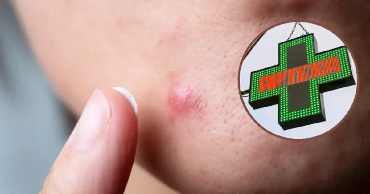 Pryszcze: Co naprawdę działa? Domowe sposoby, apteka, dermatolog