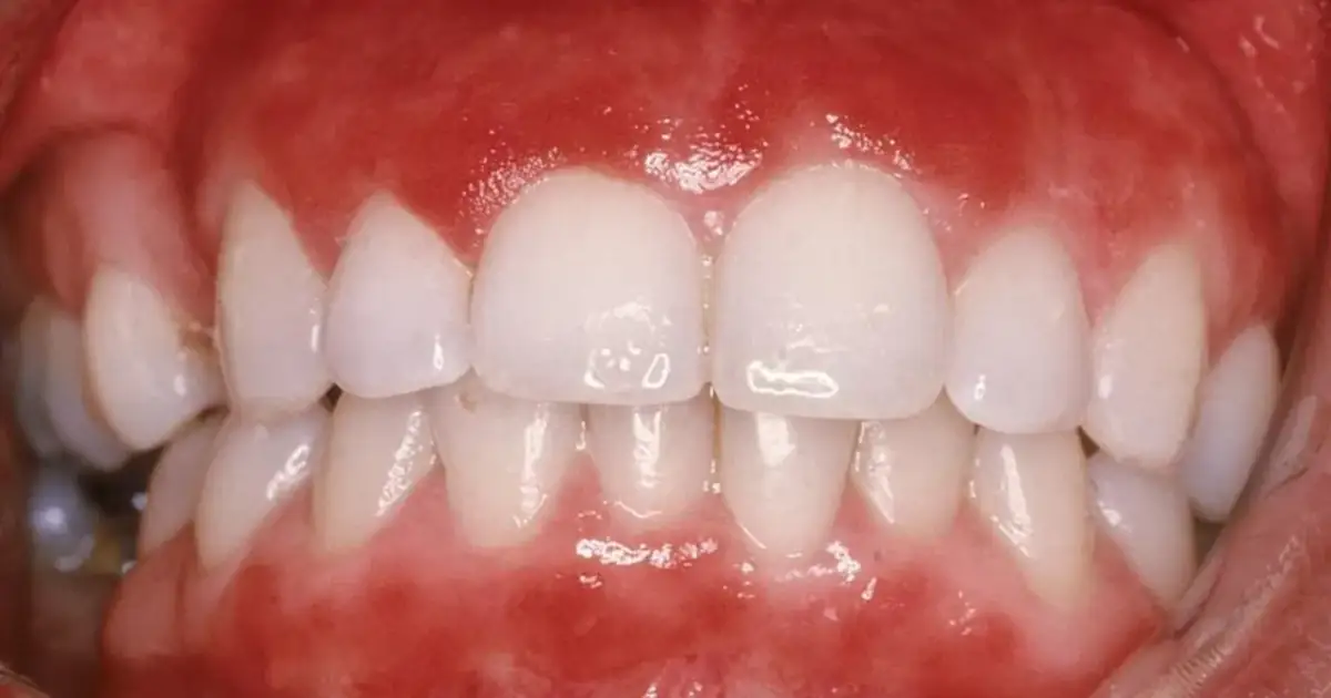 Jak wygląda zapalenie dziąseł? Objawy, które mogą cię zaskoczyć