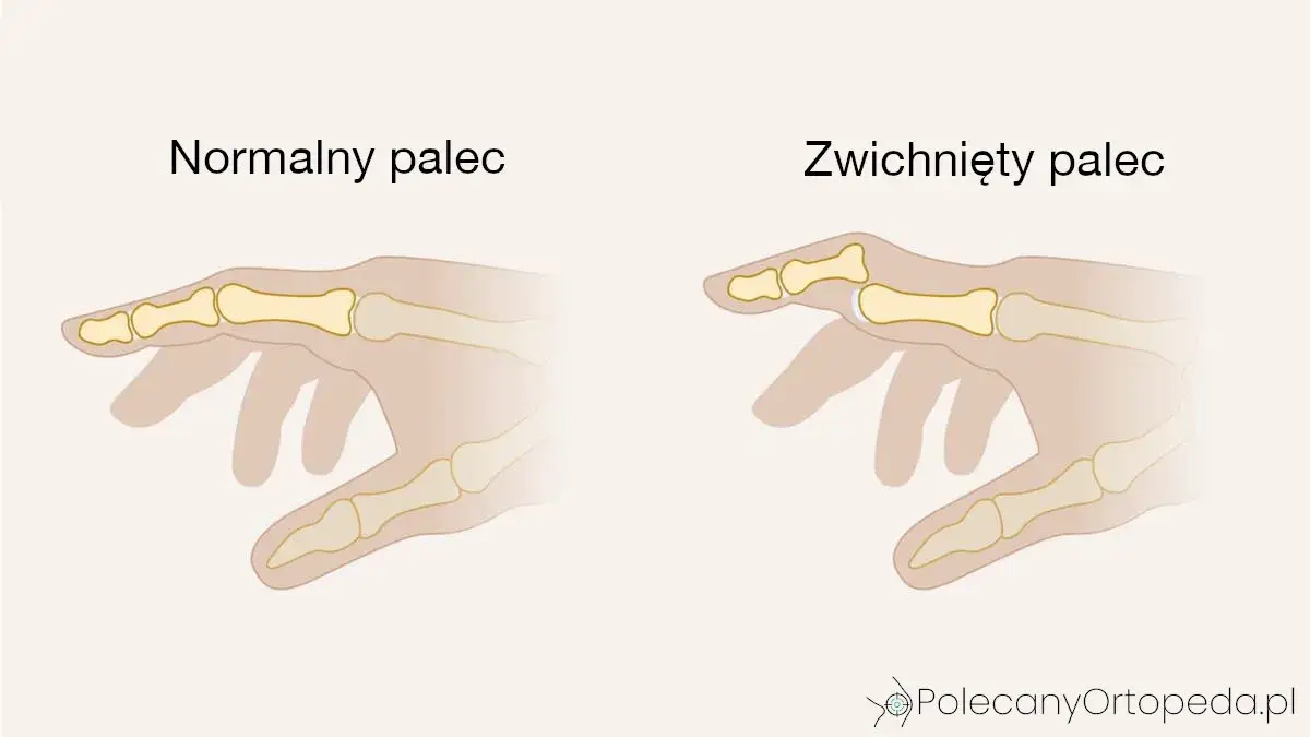 Skręcenie ręki: objawy, pierwsza pomoc i leczenie krok po kroku
