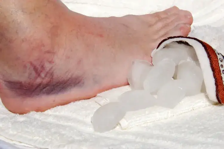 Skręcenie kostki: objawy, rozpoznanie i pierwsza pomoc