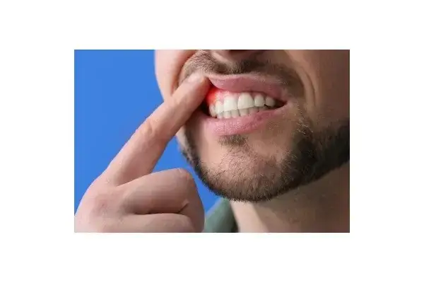 Spuchnięte dziąsło? Ulga w domu, aptece i kiedy do dentysty!