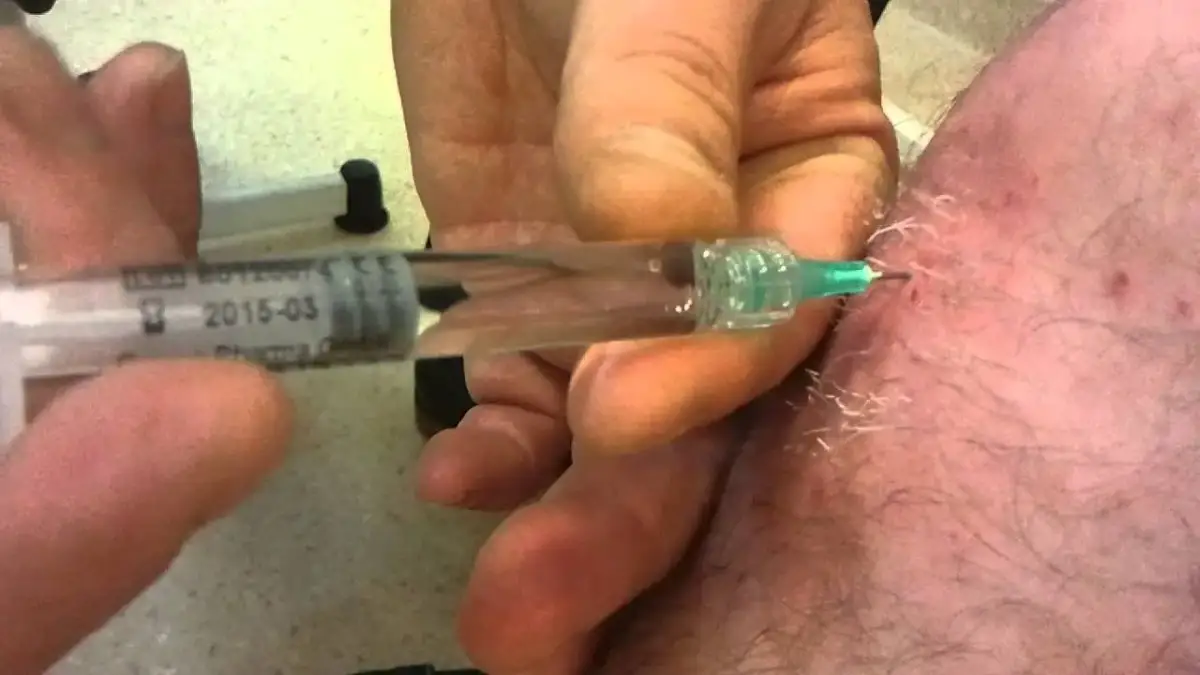 Czy zastrzyk kwasu hialuronowego w kolano boli? Co musisz wiedzieć