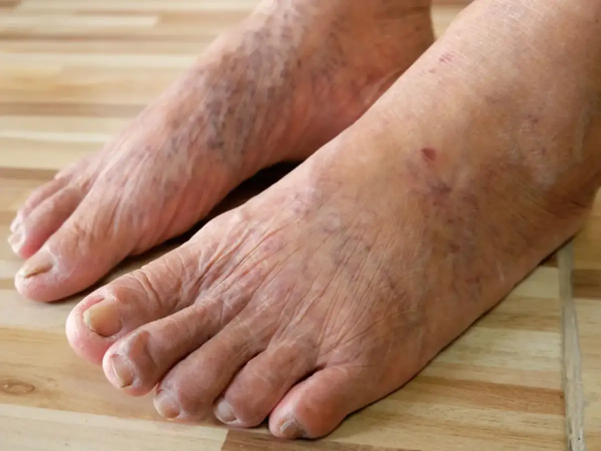 Czerwone plamy po pryszczach (PIE): Jak skutecznie je usunąć?