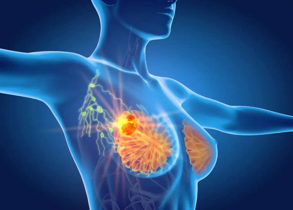 Powiększone węzły chłonne pod pachą, widoczne jako żółte kropki, wskazują na potencjalne przerzuty z guza w piersi.