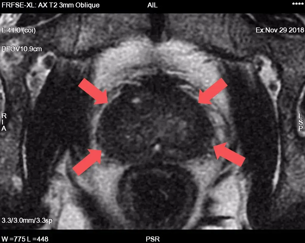 Rezonans prostaty: Jak wykryć raka? Skuteczność i wskazania