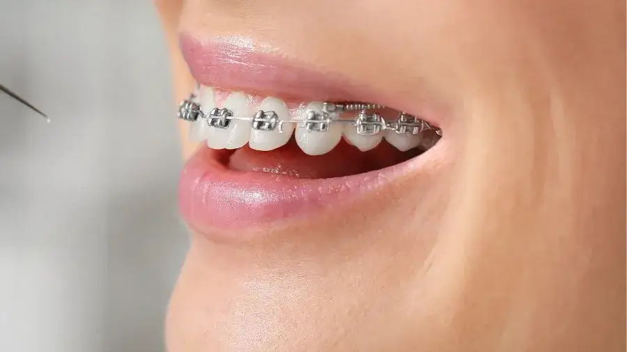 Ile nosić aparat na zęby? Średni czas i jak skrócić leczenie