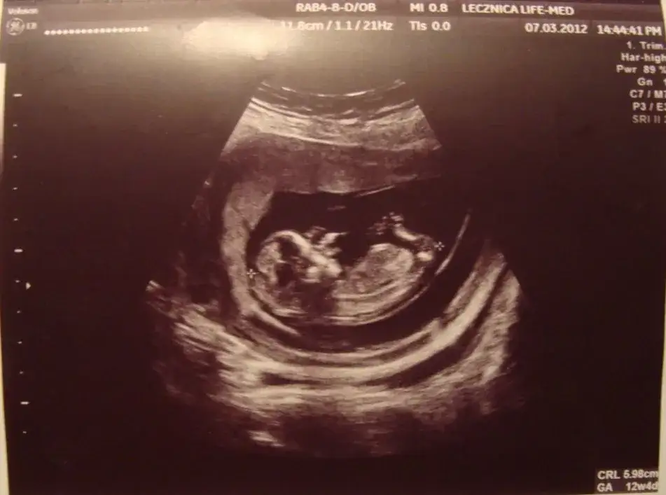 Jak wygląda dziecko w 13 tygodniu ciąży? Zaskakujące zmiany i rozwój