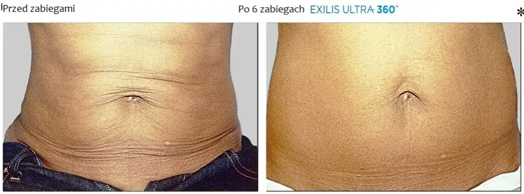 Jak pozbyć się brzucha po porodzie: 8 skutecznych metod