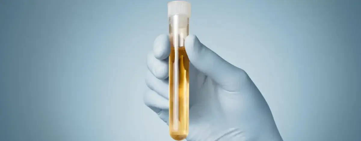 Gdzie trzymać mocz przed badaniem, aby uniknąć błędów w wynikach?