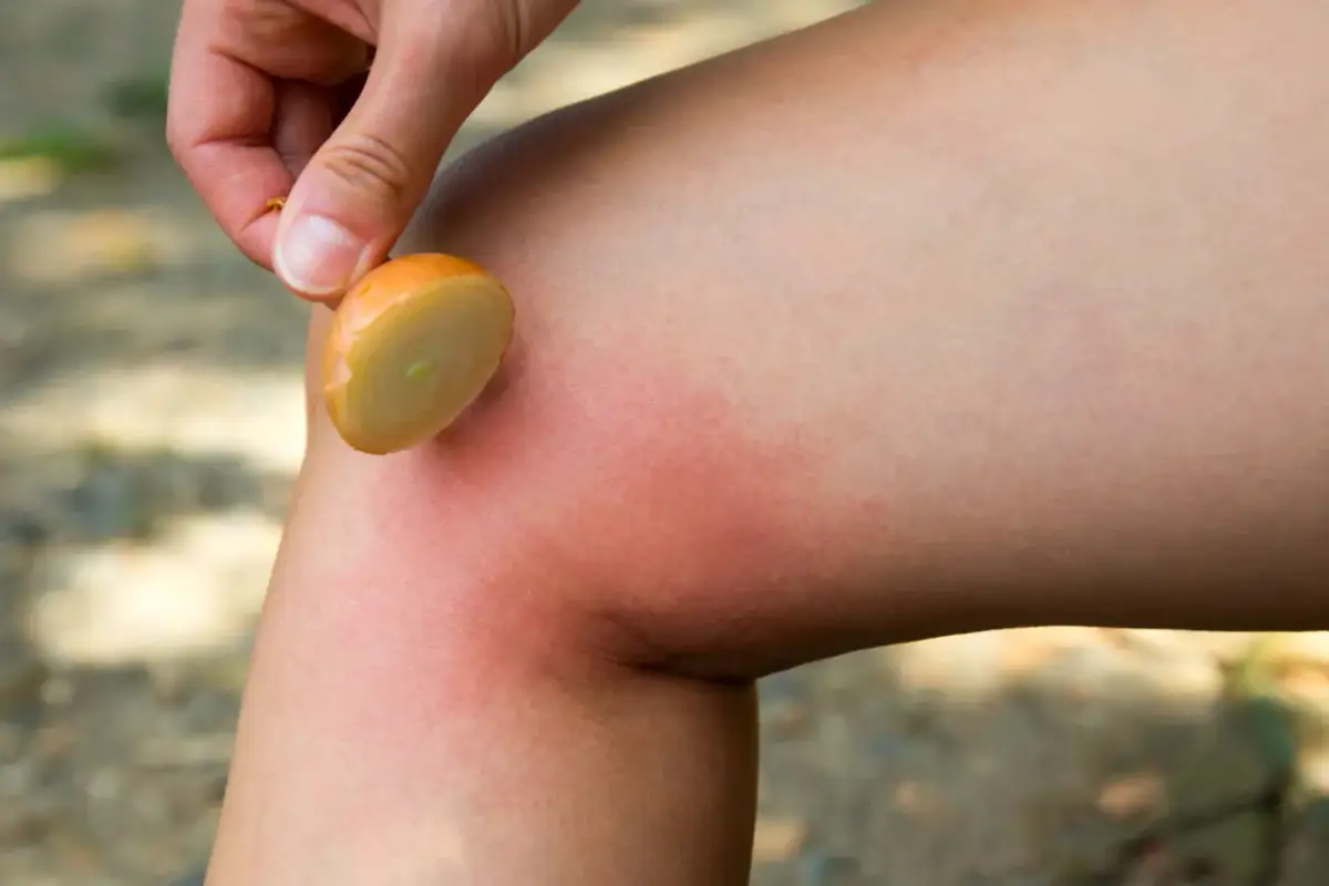 Plaster cebuli na zaczerwienioną skórę po ukąszeniu osy. To może być dobre na ukąszenie osy.