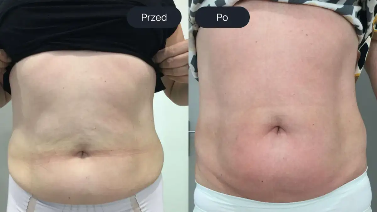Porównanie brzucha przed i po zabiegu endermologii.