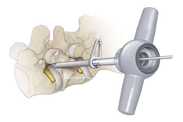 Kręgosłup lędźwiowy po operacji: ile trwa rehabilitacja i co dalej?