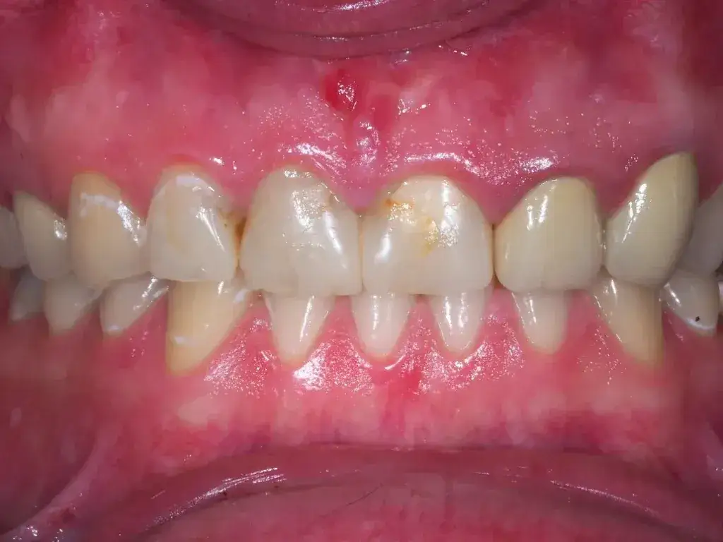 Podrażnione dziąsła: Szybka ulga i trwałe rozwiązanie. Kiedy do dentysty?