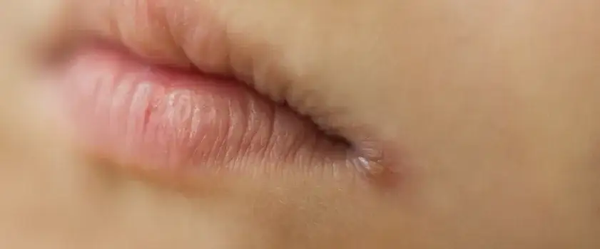 Krostki wokół ust u dziecka: skuteczne sposoby na łagodzenie podrażnień