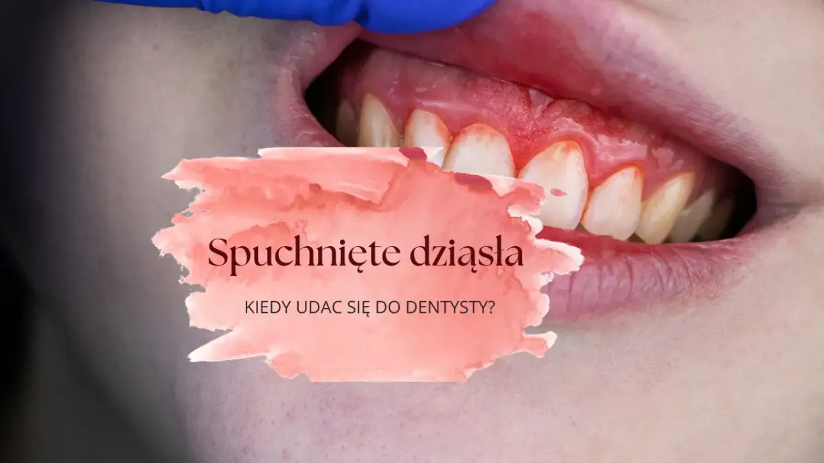 Spuchnięte dziąsło: Szybka ulga, przyczyny i kiedy do dentysty?