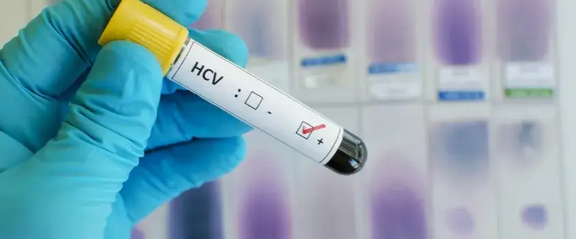 Ile kosztuje badanie HCV? Ceny, które mogą cię zaskoczyć