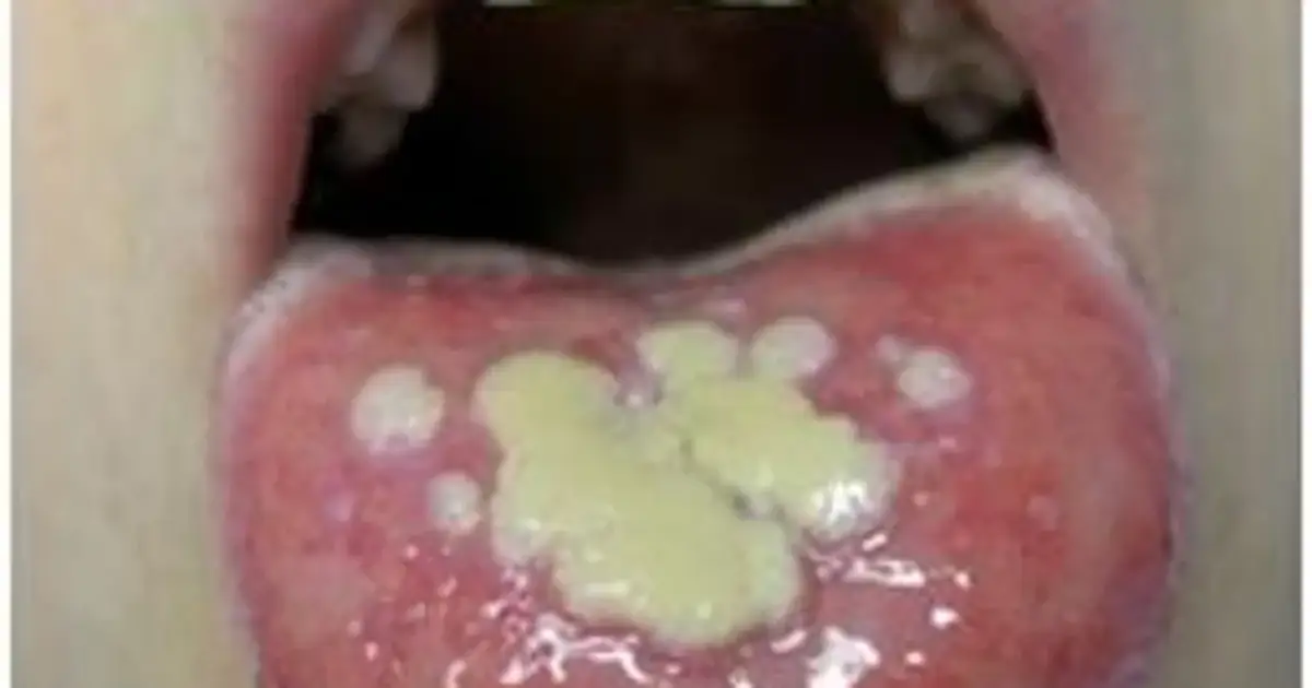 Język z licznymi, bolesnymi aftami w buzi. Biało-żółte naloty na czerwonym tle.