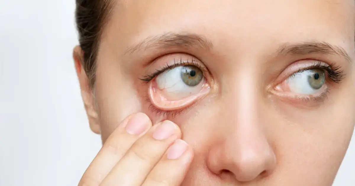 Objawy niedokrwistości z niedoboru żelaza – nie ignoruj tych sygnałów