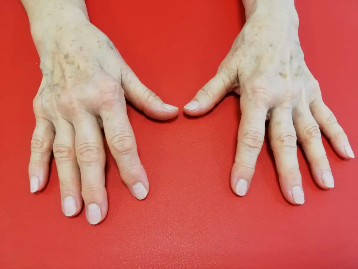 Dłonie z widocznymi zmianami skórnymi i zniekształceniami stawów, które mogą wskazywać na reumatyzm objawy.