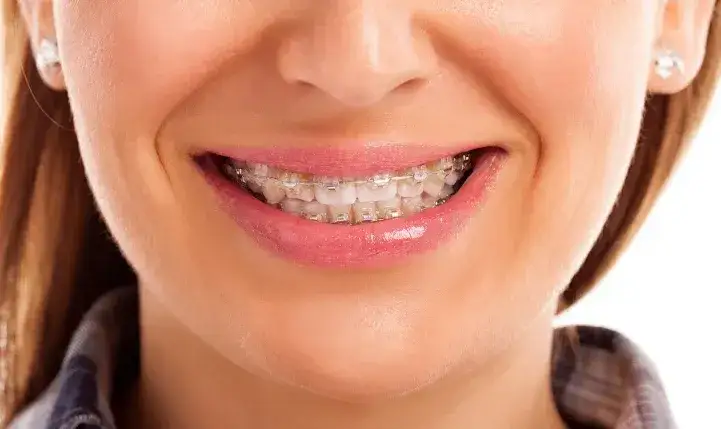 Najtańszy aparat ortodontyczny: Ile naprawdę zapłacisz? NFZ, raty