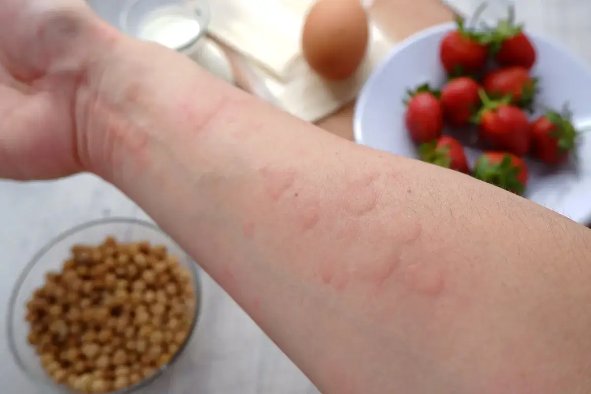 Ręka z wysypką, podejrzewane alergie krzyżowe. W tle truskawki, jajko, mleko i soja.
