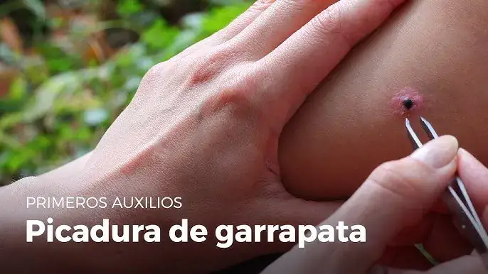 Cómo se ve la picadura de una garrapata y qué señales de alerta buscar