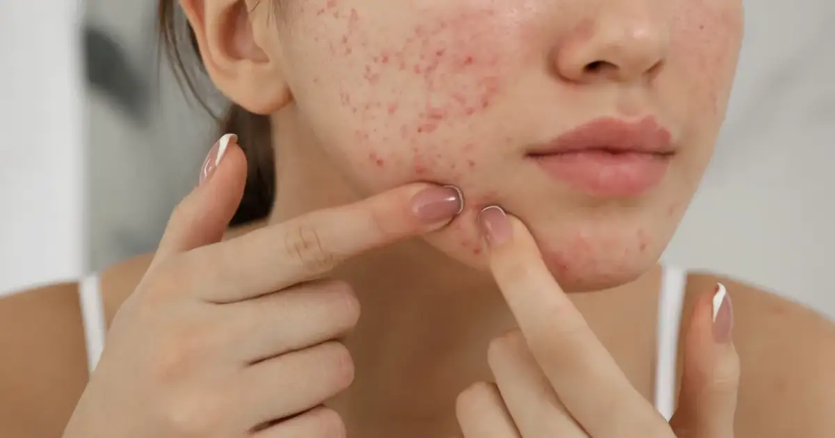 Jak szybko zagoić pryszcz? Skuteczne triki bez blizn!